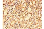 Immunohistochemistry of paraffin-embedded human gastric cancer using CSB-PA847687LA01HU at dilution of 1:100