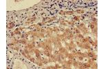 Immunohistochemistry of paraffin-embedded human liver cancer using CSB-PA848409LA01HU at dilution of 1:100