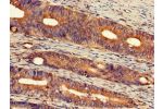 Immunohistochemistry of paraffin-embedded human colon cancer using CSB-PA849974LA01HU at dilution of 1:100