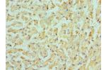 Immunohistochemistry of paraffin-embedded human liver cancer using CSB-PA850383ESR1HU at dilution 1:100