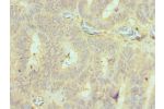 Immunohistochemistry of paraffin-embedded human colon cancer using CSB-PA850383ESR2HU at dilution 1:100