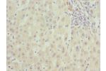 Immunohistochemistry of paraffin-embedded human liver cancer using CSB-PA850394ESR2HU at dilution 1:100