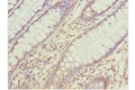 Immunohistochemistry of paraffin-embedded human colon cancer using CSB-PA850773ESR2HU at dilution 1:100