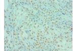 Immunohistochemistry of paraffin-embedded human colon cancer using CSB-PA852896ESR1HUat dilution 1:100