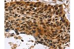 The image on the left is immunohistochemistry of paraffin-embedded Human esophagus cancer tissue using CSB-PA853298(CDX1 Antibody) at dilution 1/20, on the right is treated with fusion protein. (Original magnification: 