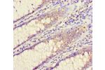 Immunohistochemistry of paraffin-embedded human colon cancer using CSB-PA853396LA01HU at dilution of 1:100