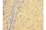 Immunohistochemistry of paraffin-embedded human liver cancer tissue using CSB-PA853399LA01HU at dilution of 1:100