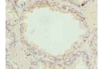 Immunohistochemistry of paraffin-embedded human prostate cancer using CSB-PA853424LA01HU at dilution of 1:100