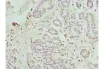 Immunohistochemistry of paraffin-embedded human breast cancer using CSB-PA853446LA01HU at dilution of 1:100