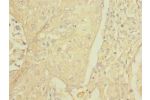 Immunohistochemistry of paraffin-embedded human lung cancer CSB-PA853454ESR2HU at dilution 1:100