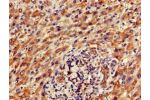 Immunohistochemistry of paraffin-embedded human liver cancer using CSB-PA853484LA01HU at dilution of 1:100