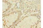 Immunohistochemistry of paraffin-embedded human colon cancer CSB-PA854161LA01HU at dilution 1:100