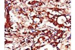 Immunohistochemistry of paraffin-embedded human gastric cancer using CSB-PA855469LA01HU at dilution of 1:100