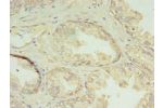 Immunohistochemistry of paraffin-embedded human prostate cancer using CSB-PA855478LA01HU at dilution of 1:100