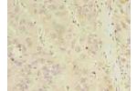 Immunohistochemistry of paraffin-embedded human liver cancer using CSB-PA855501LA01HU at dilution of 1:100