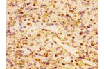 Immunohistochemistry of paraffin-embedded human glioma cancer using CSB-PA856406LA01HU at dilution of 1:100