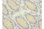 Immunohistochemistry of paraffin-embedded human colon cancer CSB-PA856889ESR2HU at dilution 1:100
