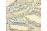 Immunohistochemistry of paraffin-embedded human endometrial cancer using CSB-PA856897LA01HU at dilution 1:100