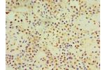 Immunohistochemistry of paraffin-embedded human breast cancer using CSB-PA856898ESR1HU at dilution 1:100
