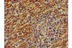 Immunohistochemistry of paraffin-embedded human liver cancer using CSB-PA856900LA01HU at dilution of 1:100