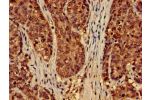 Immunohistochemistry of paraffin-embedded human ovarian cancer using CSB-PA856907LA01HU at dilution of 1:100