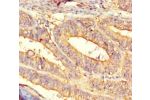 Immunohistochemistry of paraffin-embedded human endometrial cancer using CSB-PA856967HA01HU at dilution of 1:100