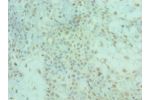 Immunohistochemistry of paraffin-embedded human breast cancer using CSB-PA857009ESR2HU at dilution 1:100