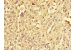 Immunohistochemistry of paraffin-embedded human melanoma CSB-PA857021ESR2HU at dilution 1:100