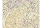 Immunohistochemistry of paraffin-embedded human lung cancer CSB-PA857449ESR1HU at dilution 1:100