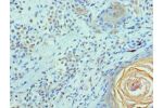 Immunohistochemistry of paraffin-embedded human breast cancer using CSB-PA857453ESR2HU at dilution 1:100