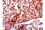 Immunohistochemistry of paraffin-embedded human lung cancer using CSB-PA857882LA01HU at dilution of 1:100