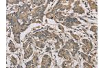 The image is immunohistochemistry of paraffin-embedded Human colon cancer tissue using CSB-PA858095(CYCS Antibody) at dilution 1/70. (Original magnification: 