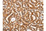 The image on the left is immunohistochemistry of paraffin-embedded Human thyroid cancer tissue using CSB-PA858560(AIM2 Antibody) at dilution 1/60, on the right is treated with fusion protein. (Original magnification: 