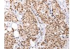 The image on the left is immunohistochemistry of paraffin-embedded Human breast cancer tissue using CSB-PA858674(BRMS1 Antibody) at dilution 1/25, on the right is treated with synthetic peptide. (Original magnification: 