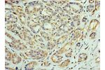 Immunohistochemistry of paraffin-embedded human breast cancer using CSB-PA858715ESR2HU at dilution 1:100