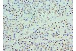 Immunohistochemistry of paraffin-embedded human breast cancer using CSB-PA859111ESR2HU at dilution 1:100