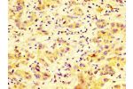 IHC image of CSB-PA859528LA01HU diluted at 1:600 and staining in paraffin-embedded human liver cancer performed on a Leica BondTM system. After dewaxing and hydration, antigen retrieval was mediated by high pressure in a citrate buffer (pH 6.0). Section w