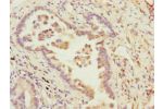 Immunohistochemistry of paraffin-embedded human lung cancer using CSB-PA861077ESR1HU at dilution of 1:100