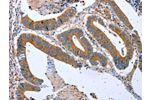 The image on the left is immunohistochemistry of paraffin-embedded Human colon cancer tissue using CSB-PA861106(CPT1A Antibody) at dilution 1/20, on the right is treated with fusion protein. (Original magnification: 