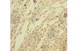 Immunohistochemistry of paraffin-embedded human pancreatic cancer using CSB-PA861147LA01HU at dilution 1:100