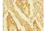 Immunohistochemistry of paraffin-embedded human pancreatic cancer using CSB-PA861193LA01HU at dilution of 1:100