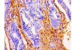 Immunohistochemistry of paraffin-embedded human colon cancer using CSB-PA861938LA01HU at dilution of 1:100