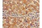 Immunohistochemistry of paraffin-embedded human liver cancer using CSB-PA861986LA01HU at dilution of 1:100