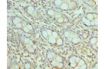 Immunohistochemistry of paraffin-embedded human rectal cancer using CSB-PA862043ESR2HU at dilution 1:100