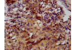 IHC image of CSB-PA862050LA01HU diluted at 1:400 and staining in paraffin-embedded human ovarian cancer performed on a Leica BondTM system. After dewaxing and hydration, antigen retrieval was mediated by high pressure in a citrate buffer (pH 6.0). Section
