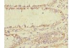 Immunohistochemistry of paraffin-embedded human colon cancer CSB-PA862062LA01HU at dilution 1:100