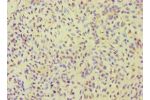 Immunohistochemistry of paraffin-embedded human breast cancer using CSB-PA863156ESR1HU at dilution 1:100