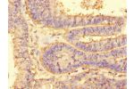 Immunohistochemistry of paraffin-embedded human endometrial cancer tissue using CSB-PA863983LA01HU at dilution of 1:100