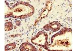 Immunohistochemistry of paraffin-embedded human prostate cancer using CSB-PA863993LA01HU at dilution of 1:100