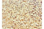 Immunohistochemistry of paraffin-embedded human glioma using CSB-PA864024ESR2HU at dilution 1:100